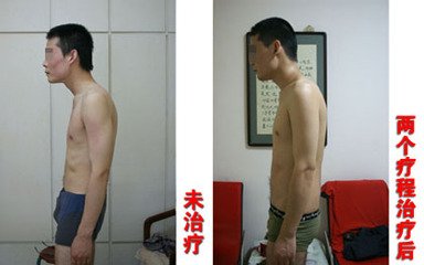 强直性脊柱炎治疗要注意什么 强直性脊柱炎治疗要注意什么