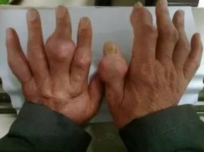 急性痛风性关节炎.jpg 急性痛风性关节炎.jpg