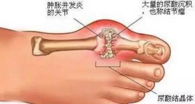 慢性痛风石病变期.jpg 慢性痛风石病变期.jpg