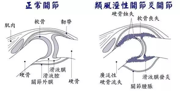 类风湿关节炎严重时会累及身体多个器官.jpg 类风湿关节炎严重时会累及身体多个器官.jpg
