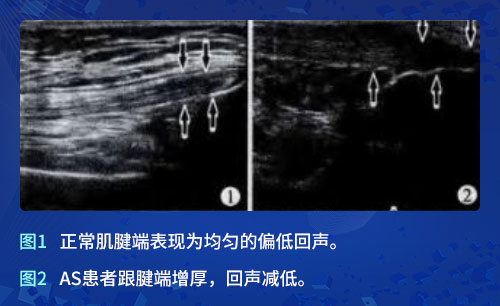 欧美新一代MSUS肌骨超声技术 欧美新一代MSUS肌骨超声技术