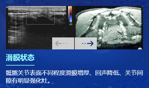 欧美新一代MSUS肌骨超声技术 欧美新一代MSUS肌骨超声技术