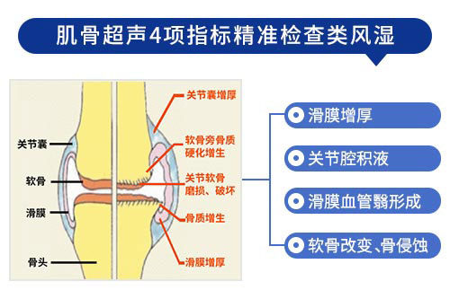 欧美新一代MSUS肌骨超声技术
