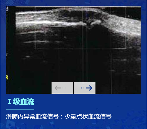 欧美新一代MSUS肌骨超声技术