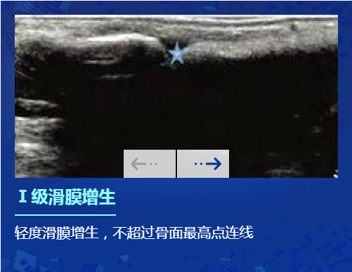 欧美新一代MSUS肌骨超声技术