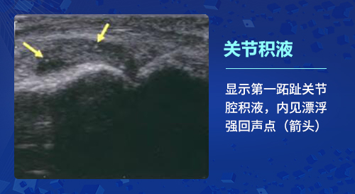 关节积液 新一代肌骨超声技术