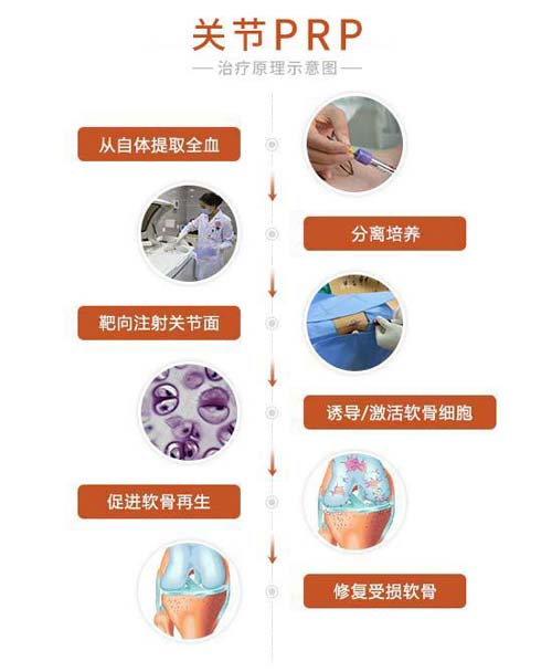 关节PRP技术 关节PRP技术治疗关节疾病