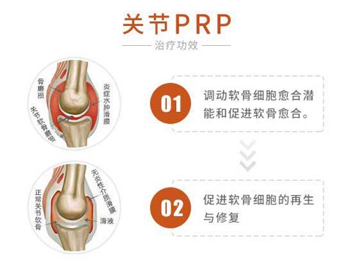 关节PRP技术治疗功效 关节PRP技术治疗关节疾病