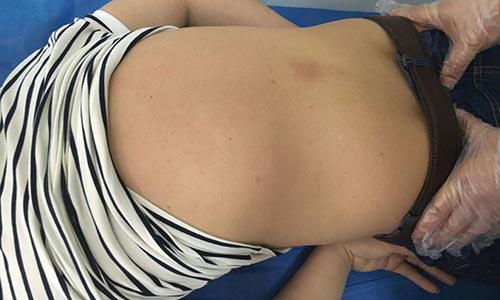 (图：治疗后，牛先生脊柱变形迹象得到抑制，疼痛缓解)