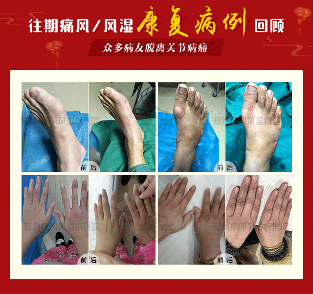 2020《迎元旦·送健康》风湿疾病“ 健康公益援助 ”行动 暨2020年首届风湿骨关节病多学科联合普查会诊 2020《迎元旦·送健康》风湿疾病“ 健康公益援助 ”行动 暨2020年首届风湿骨关节病多学科联合普查会诊