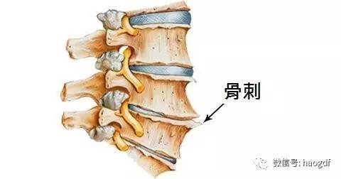 强直性脊柱炎会带来哪些并发症呢？郑州强直性脊柱炎专科医院